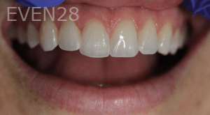 Sean-Nguyen-Dental-Bonding-after-1