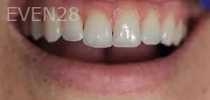 Sean-Nguyen-Dental-Bonding-before-1