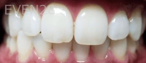 Sherry-Darabi-Teeth-Whitening-after-2