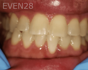 Sherry-Darabi-Teeth-Whitening-before-1
