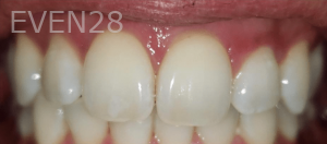 Sherry-Darabi-Teeth-Whitening-before-2