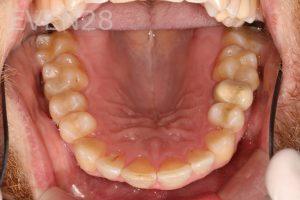 Stephen-Coates-Invisalign-Clear-Aligners-after-2