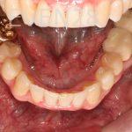 Stephen-Coates-Invisalign-Clear-Aligners-after-2b