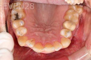 Stephen-Coates-Invisalign-Clear-Aligners-before-2