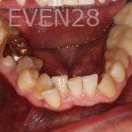 Stephen-Coates-Invisalign-Clear-Aligners-before-2b