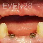 Steven-Son-Full-Mouth-Dental-Implants-before-1