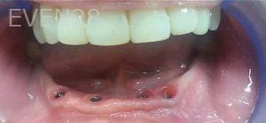 Steven-Son-Implant-Supported-Dentures-before-1