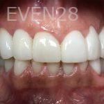 Tamlyn-Lee-Dental-Implants-after-4