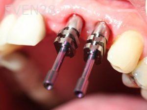 Tamlyn-Lee-Dental-Implants-before-1