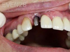 Tamlyn-Lee-Dental-Implants-before-2