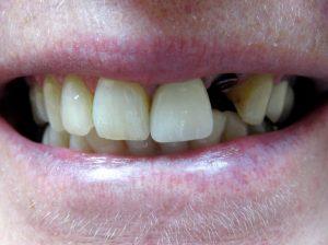 Tamlyn-Lee-Dental-Implants-before-3