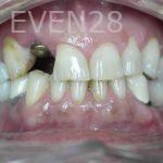 Tamlyn-Lee-Dental-Implants-before-4