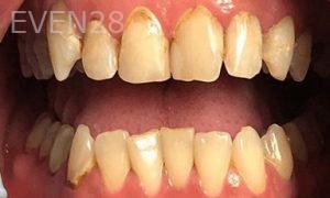 Tao-Sun-Dental-Crowns-before-2