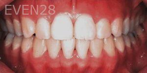 Tao-Sun-Orthodontic-Braces-after-1