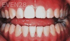 Tao-Sun-Orthodontic-Braces-after-1b