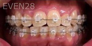 Tao-Sun-Orthodontic-Braces-after-2
