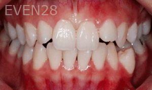 Tao-Sun-Orthodontic-Braces-before-1