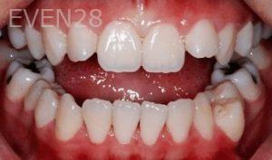 Tao-Sun-Orthodontic-Braces-before-1b