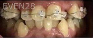 Tao-Sun-Orthodontic-Braces-before-2