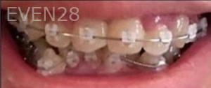 Tao-Sun-Orthodontic-Braces-before-2b