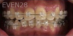 Tao-Sun-Orthodontic-Braces-before-2c