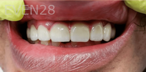 Thayer-Hussein-Dental-Crowns-after-1