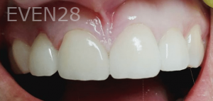 Thayer-Hussein-Dental-Crowns-after-2