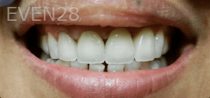 Thayer-Hussein-Dental-Crowns-after-3