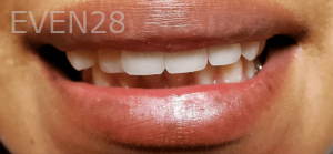 Thayer-Hussein-Dental-Crowns-after-4