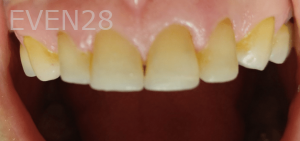 Thayer-Hussein-Dental-Crowns-after-5-Copy