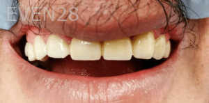 Thayer-Hussein-Dental-Crowns-before-1