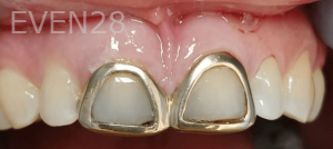 Thayer-Hussein-Dental-Crowns-before-2