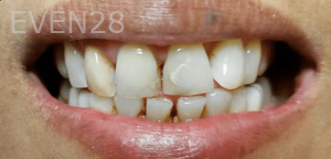 Thayer-Hussein-Dental-Crowns-before-3