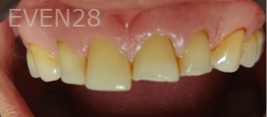 Thayer-Hussein-Dental-Crowns-before-5