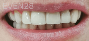 Thayer-Hussein-Dental-Implants-after-1