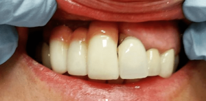 Thayer-Hussein-Dental-Implants-after-2