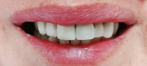 Thayer-Hussein-Dental-Implants-after-2b