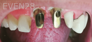 Thayer-Hussein-Dental-Implants-before-1