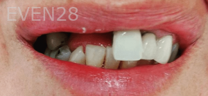 Thayer-Hussein-Dental-Implants-before-2b