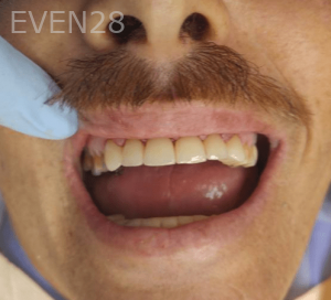 Thayer-Hussein-Full-Mouth-Rehabilitation-after-5