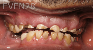 Thayer-Hussein-Full-Mouth-Rehabilitation-before-1