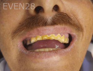 Thayer-Hussein-Full-Mouth-Rehabilitation-before-5