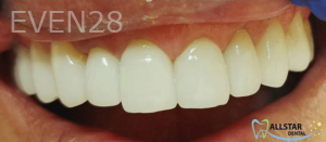 Thayer-Hussein-Porcelain-Veneers-after-1