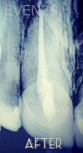 Thayer-Hussein-Root-Canal-Treatment-after-1