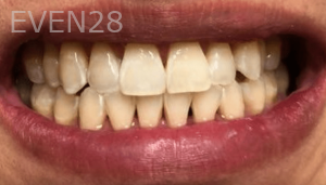 Thayer-Hussein-Teeth-Whitening-after-2