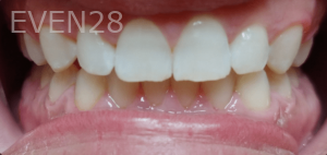 Thayer-Hussein-Teeth-Whitening-after-3