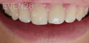 Thayer-Hussein-Teeth-Whitening-after-4