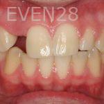 Ting-Wey-Yen-Dental-Implants-before-1