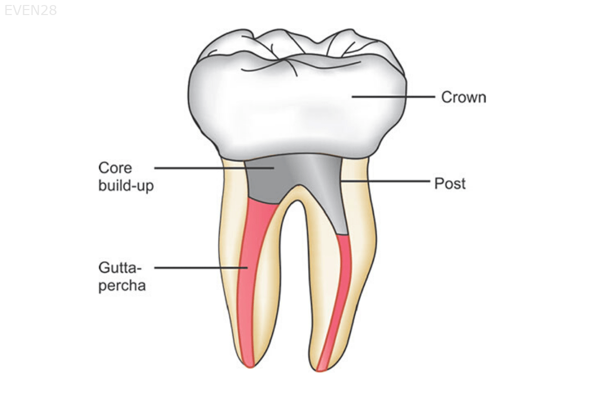 Root Canal, Post & Crown (Any Tooth) - Ideal Dental Care ...