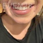 Vivian-Yin-Invisalign-Clear-Aligners-after-1